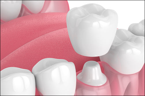 Dental Crowns