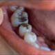Dental Filling