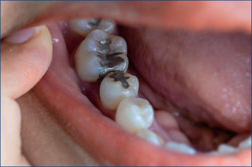 Dental Filling