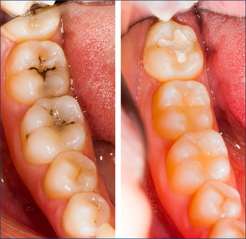 Dental Filling