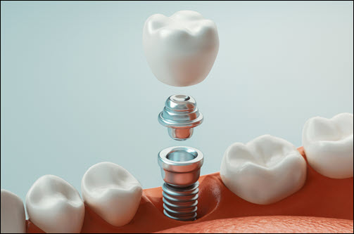 Dental Implant