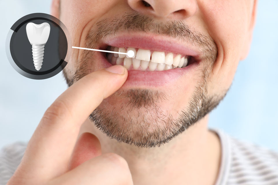 Dental Implant