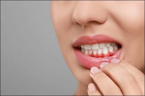 Gingivitis