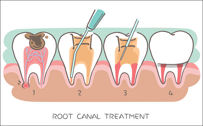 Root Canal