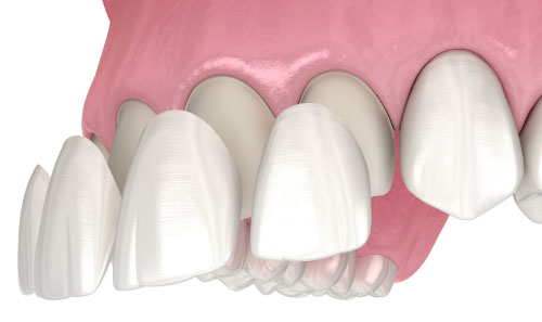Teeth Bonding - Contemporary Family Dentistry