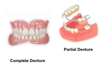 Temporary Dentures vs. Permanent Dentures - Pickett Family Dental
